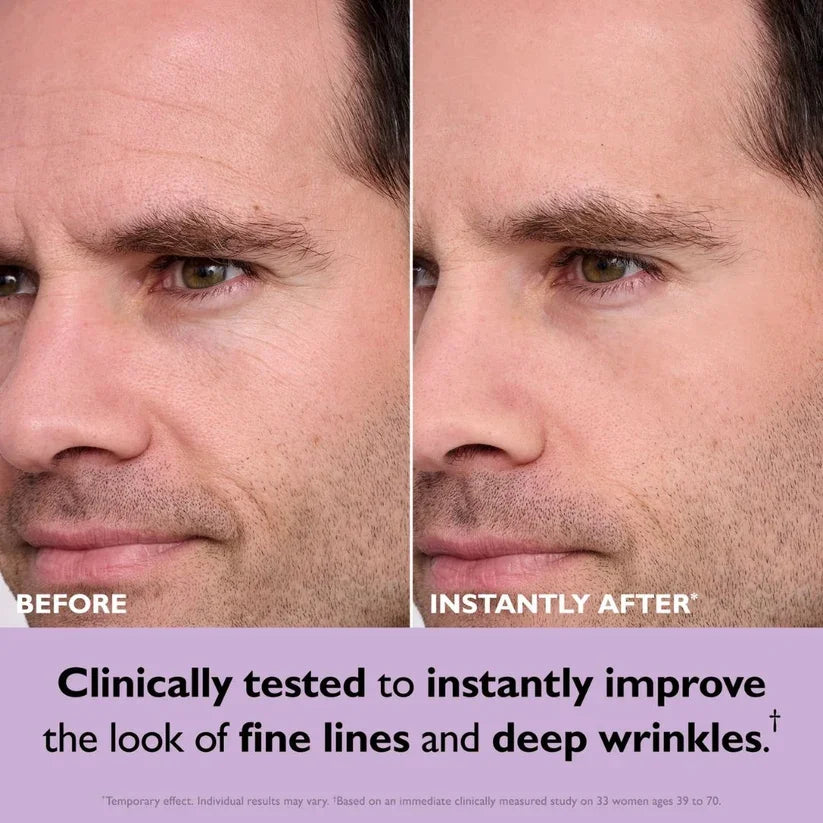Fine lines and wrinkles before and after